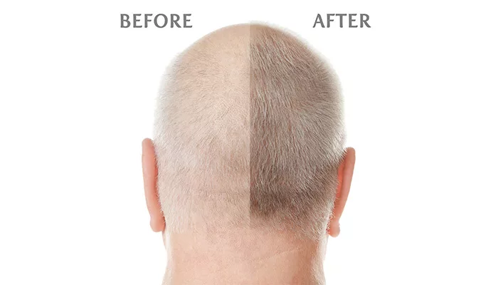 How to stop hair fall in male ?